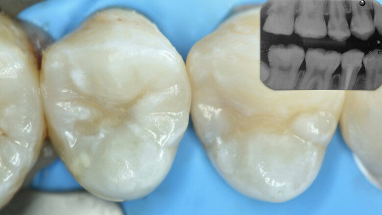 Figura 19. Radiografía bite-wing, donde se observan lesiones de caries en piezas 24 y 25 en paciente femenina (Caso 2).