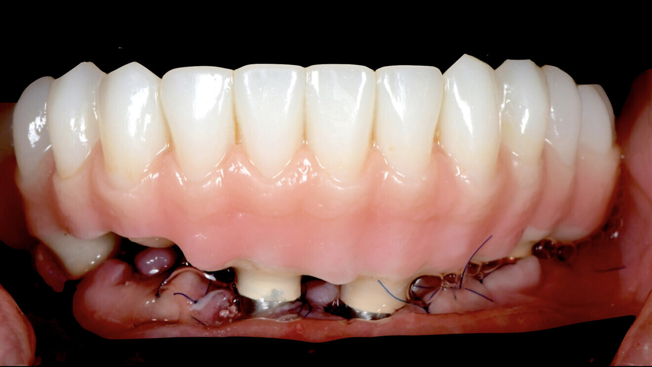 Fig. 13: The provisional prosthesis in situ. 
