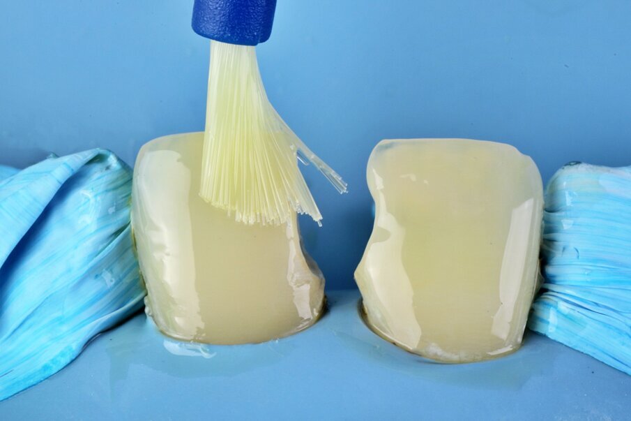 Fig. 5: Application of 7th generation Bonding Agent on the entire surface of the prepared tooth #11 & 21.
