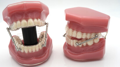 The orthocaps Rainmaker appliance: Clinical illustration and conclusions