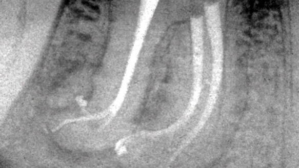 Negotiating around anatomic impediments: Tactile clues, bypass techniques, procedural flow