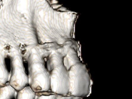 Fig.5: 3 D rendition of CBCT at 1 yr showing increased buccal bone support