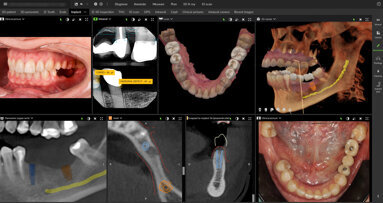 DEXIS lancia la nuova release di DTX Studio Clinic