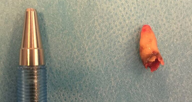 Case report presents rare incidence of retained tooth in nasal cavity