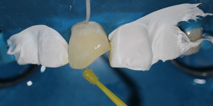 Fig 8: Application of Universal Bonding agent