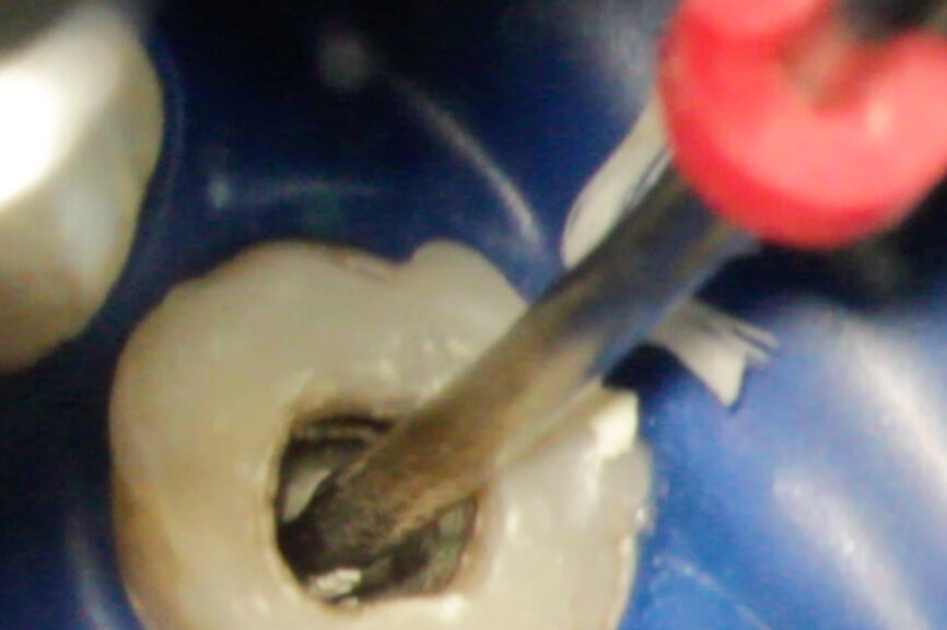 Fig. 2c: (a) Endodontically treated tooth with fistula. (b) After retreatment, the tooth showed an open apex. (c) MTA application with the MAP System and PD MTA White. Condensation of the MTA with pluggers (d) or paper points (e). (f) MTA plug. (g) Post-op radiograph showing the MTA plug and the reconstruction with a fibre post.