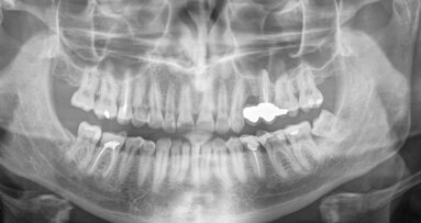 Endodontic treatment of maxillary left first molar with complicated root canal system