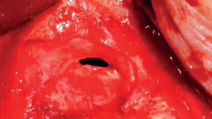 Complicaciones intraoperatorias