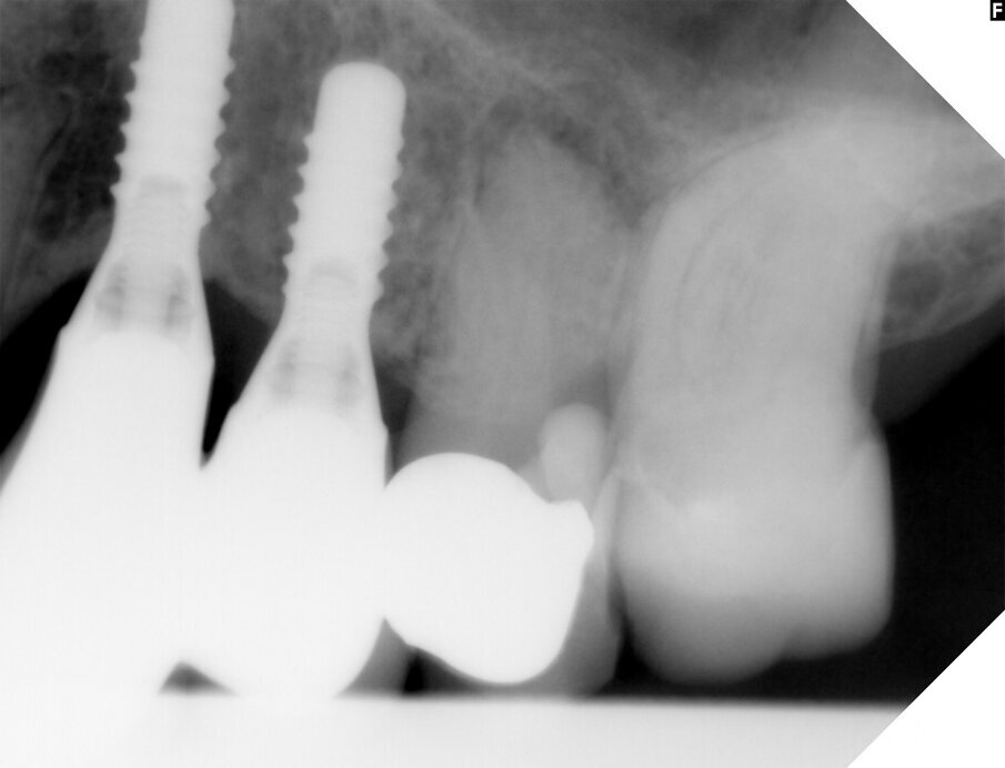 Fig. 1: The radiograph showed an ongoing pathological process in the bone in the apical area of the root.