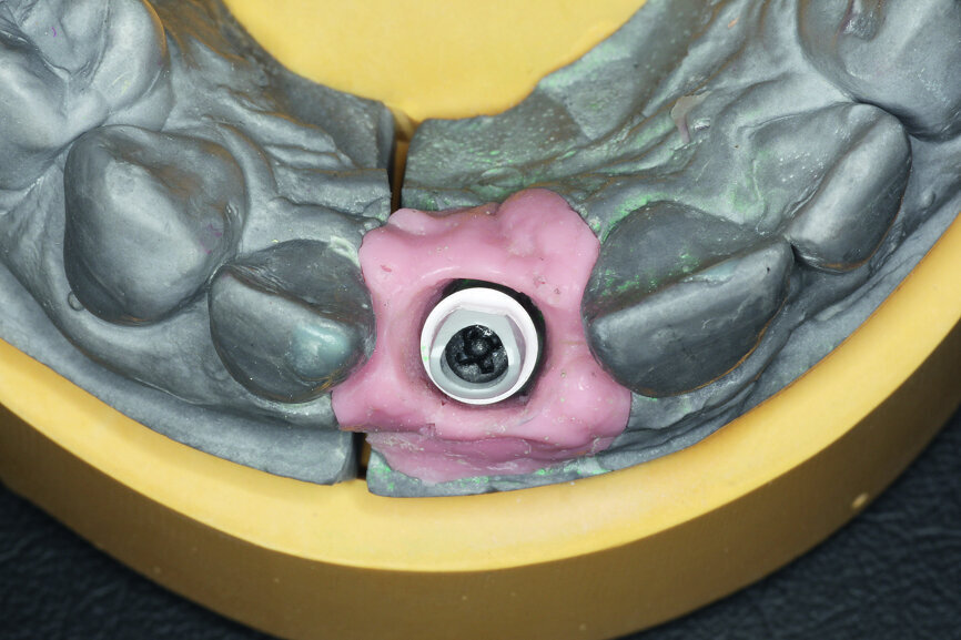 Fig. 9b: The definitive zirconia crown was fixed to the customised abutment made of alumina-toughened zirconia.