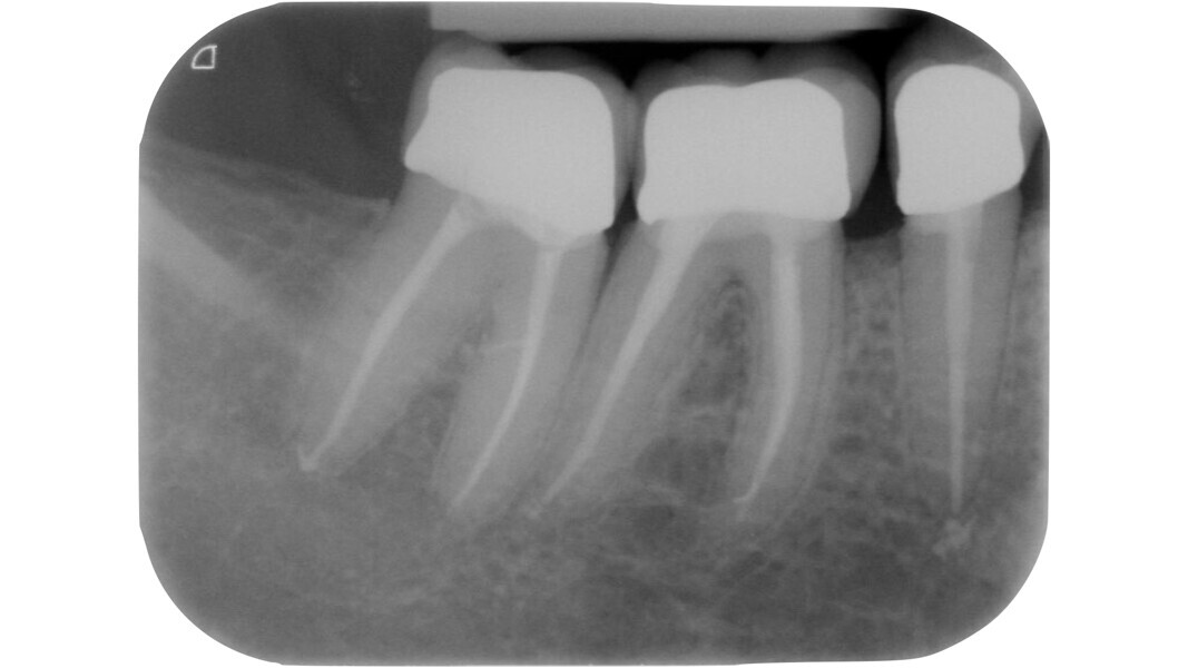 Fig. 12 : Radiographie réalisée après la fin du traitement prothétique dans le quadrant 4.