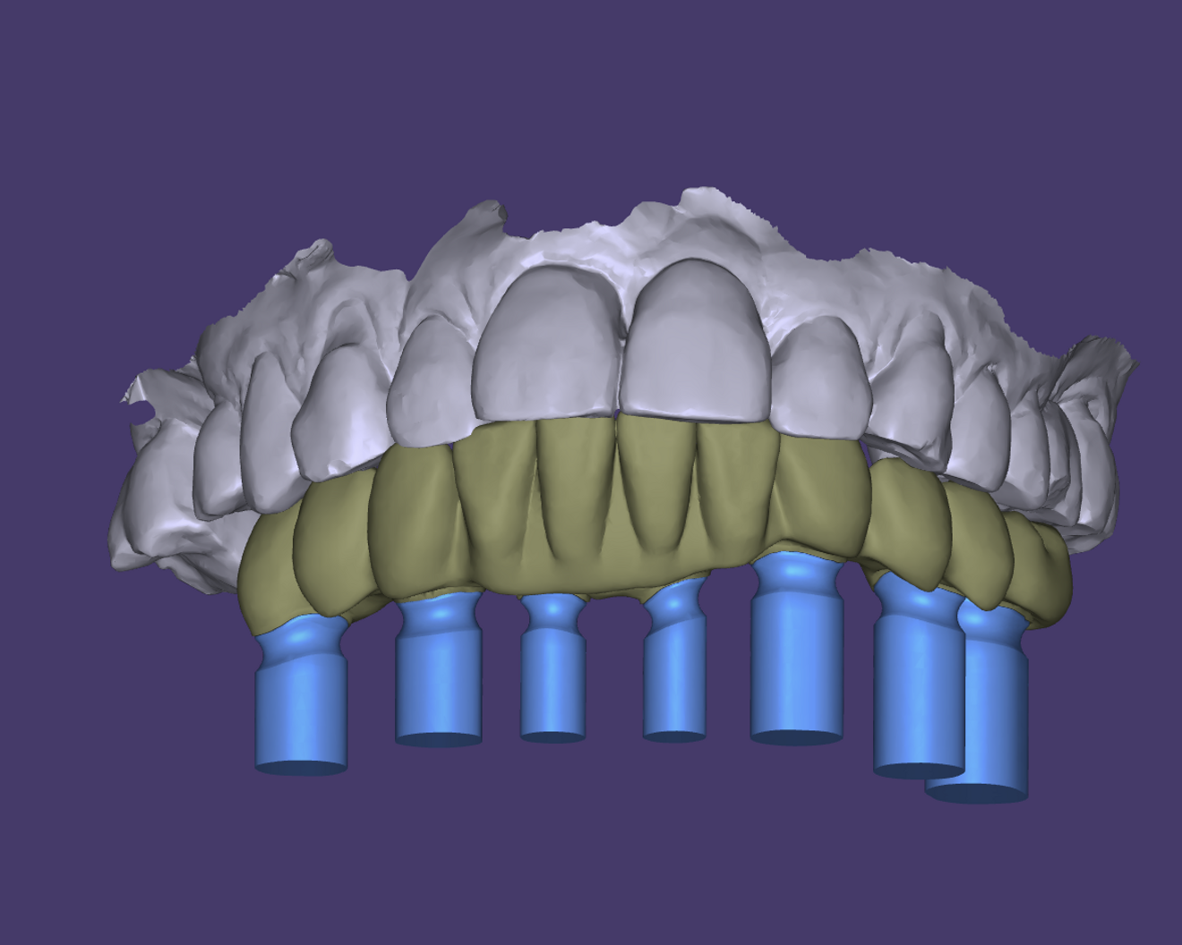 Fig. 16: Laboratory model of the prepared abutments indexed for final restoration.