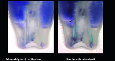 The effect of partial vacuum on the chemical preparation of the root canal system