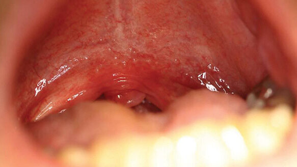 Silence snoring with ‘NIGHTLASE’ and cutting-edge laser esthetic applications