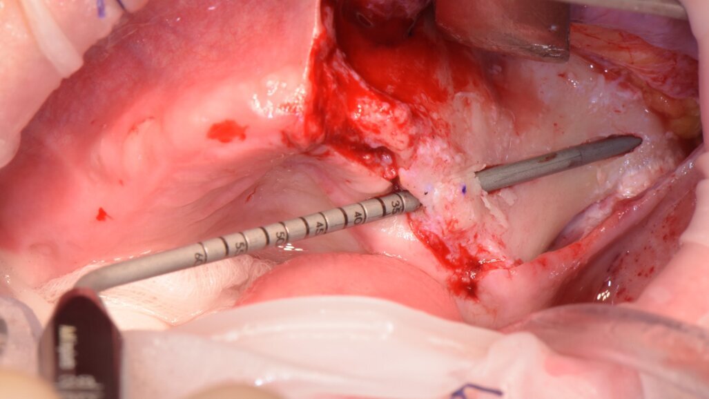 Il trattamento delle gravi atrofie mascellari con impianti zigomatici: una nuova Tecnica Minimamente Invasiva con strumentazione piezoelettrica