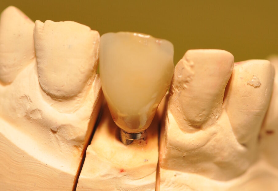 Fig. 8_Corona Definitiva in LP e Ceramica sul modello.