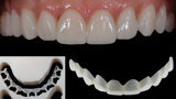 Fig. 12b. Restauraciones provisionales intraorales (Telio CAD).