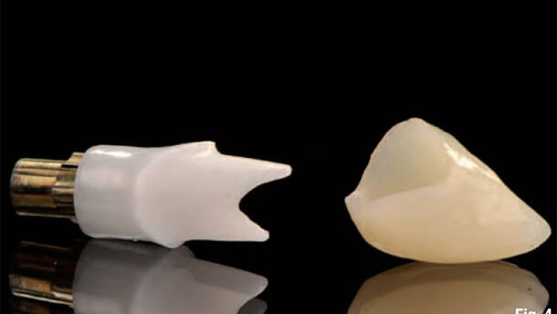 Customised abutments for long-term aesthetics