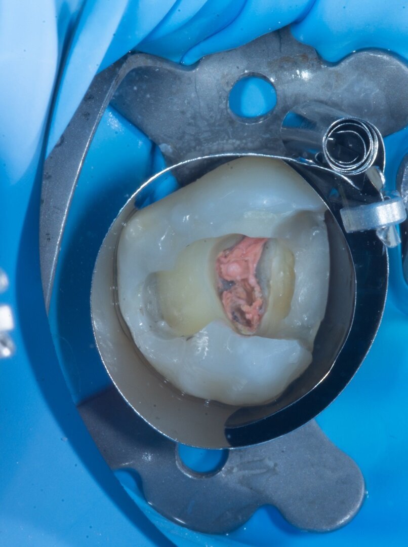Fig. 4: After endodontic treatment and deep marginal elevation.