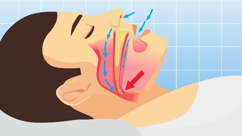 Rivisitazione delle linee guida mondiali per la diagnosi delle apnee notturne