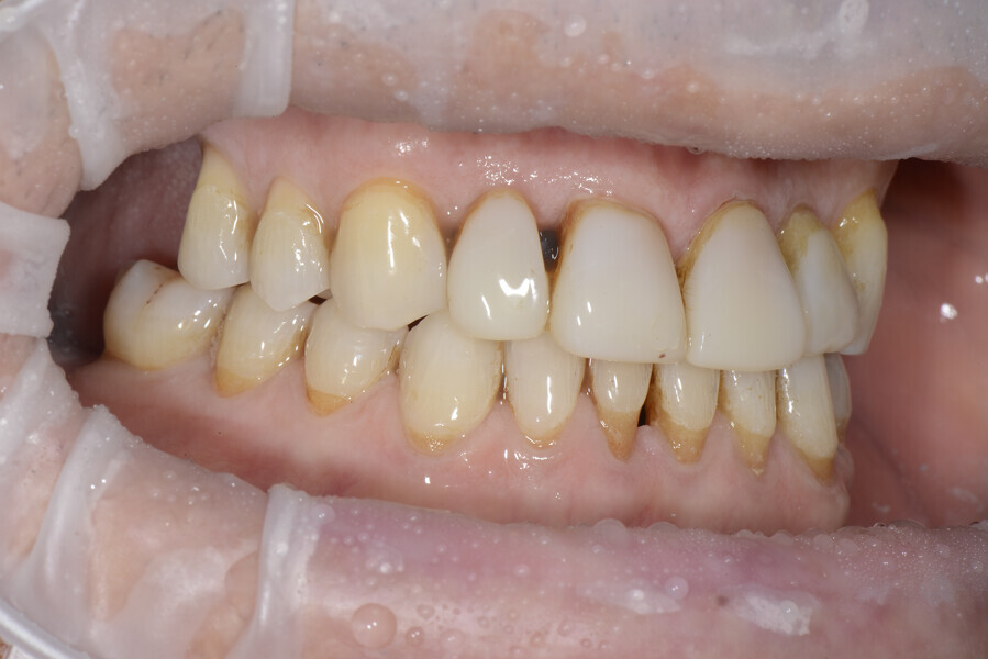 Figs. 23a–e: Situation at the end of the orthodontic refinement.