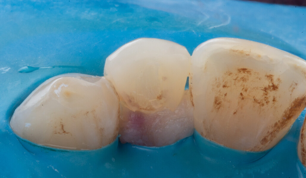 Fig. 5: Palatal view of the tooth during layering.