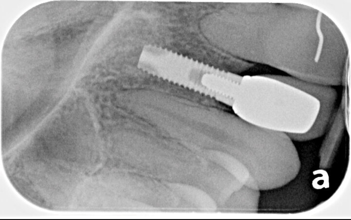 Fig. 1. Implant radiograph at recall appointment shows stable bone levels and a secure restoration.