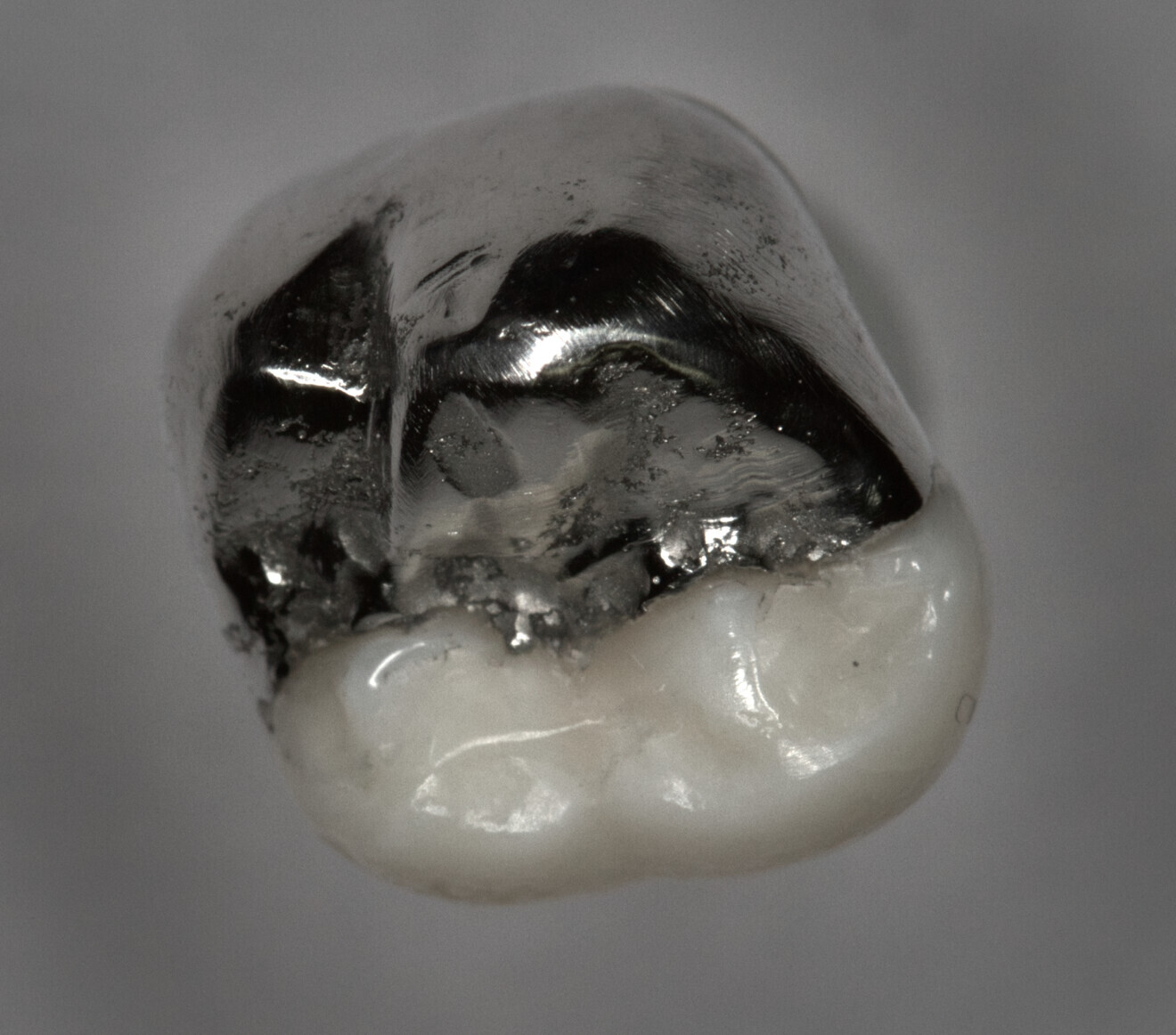 Fig. 7: Cemented onlay.