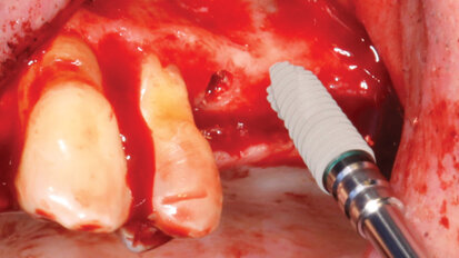Safe, accurate, simplified sinus lift technique for general practitioners, Part 1: Crestal sinus approach innovation