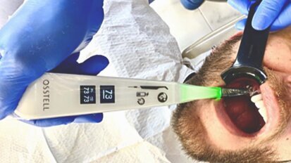 ¿Cómo predecir el éxito de los implantes?