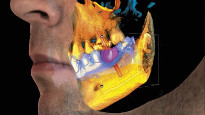 Pořizujte CBCT snímky s ultranízkou účinnou dávkou záření a bez pohybových artefaktů