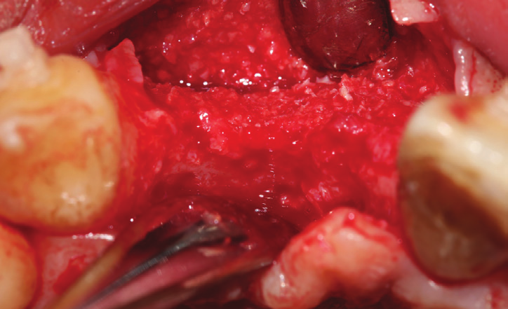 Figure 17: 5 months intraoral view shows ridge augmentation that permitted implant placement in ideal prosthetic position.