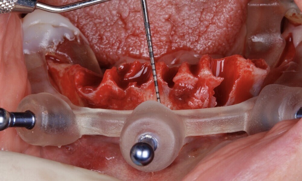 Figs. 36–39: The second surgical guide was placed, followed by bone reduction.