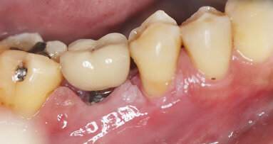 EFP releases peer-reviewed guideline on peri-implant disease prevention and treatment