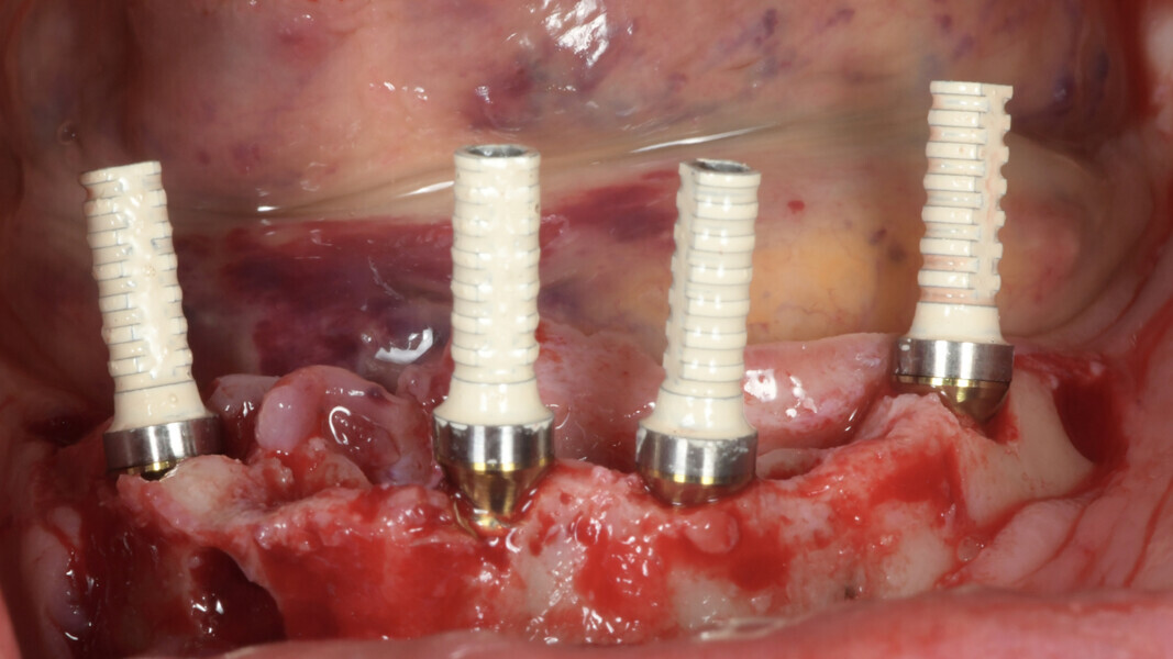 Fig. 11: The temporary titanium abutments screwed on to the prosthetic abutments.