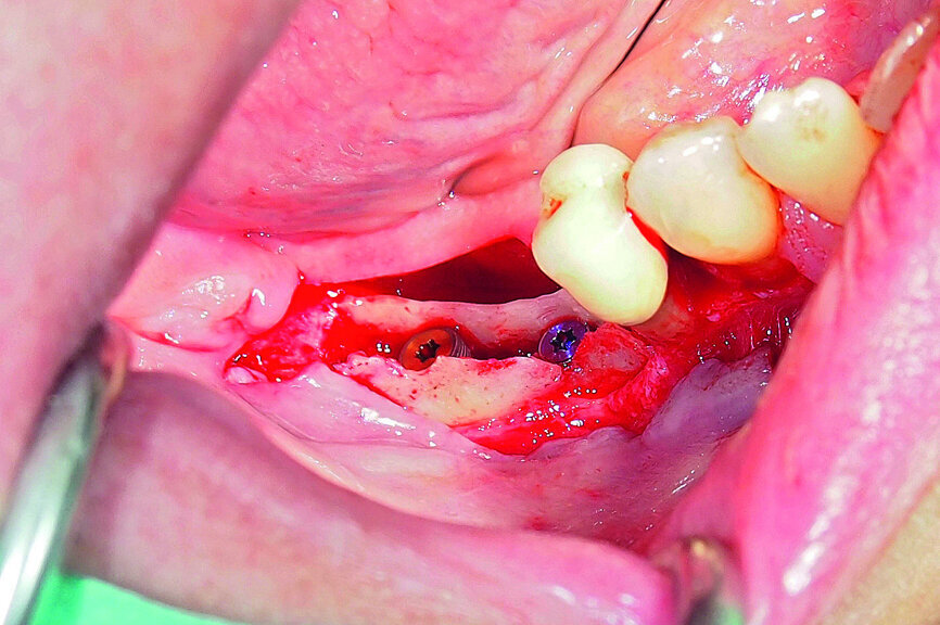 Fig. 18: Placement of two GC Aadva Standard implants with regard to the future restorative margins.