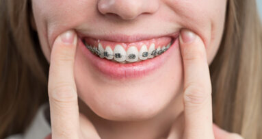 Perio-ortho synergy: “Excellent periodontal health is mandatory for a predictable orthodontic outcome”