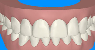 Smile Makeover: Ortodonzia preprotesica finalizzata alla Cosmesi odontoiatrica