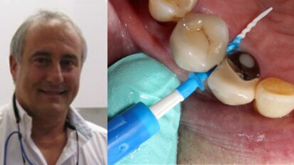 Un original dispositivo para la limpieza interdental