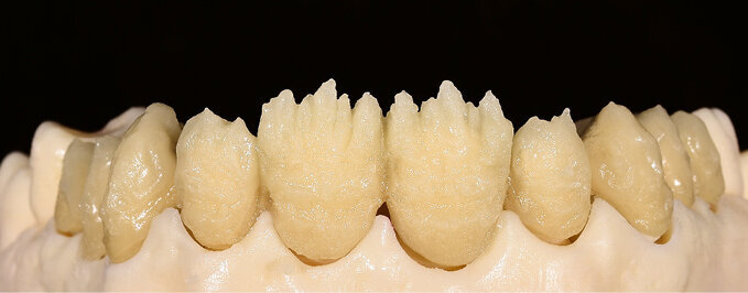 Fig. 8 & 9: The ceramic materials were mixed with Liquid Visual Eyes for the purpose of visually comparing the two materials during the layering proces (left: IPS d.SIGN; right: IPS Style)