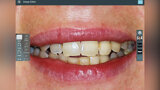 Fig. 2. Se simularon selectivamente los incisivos centrales ideales usando el software Smile Designer Pro.