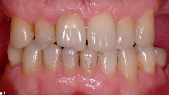 Fixed prosthodontic management of a mutilated dentition: A team approach
