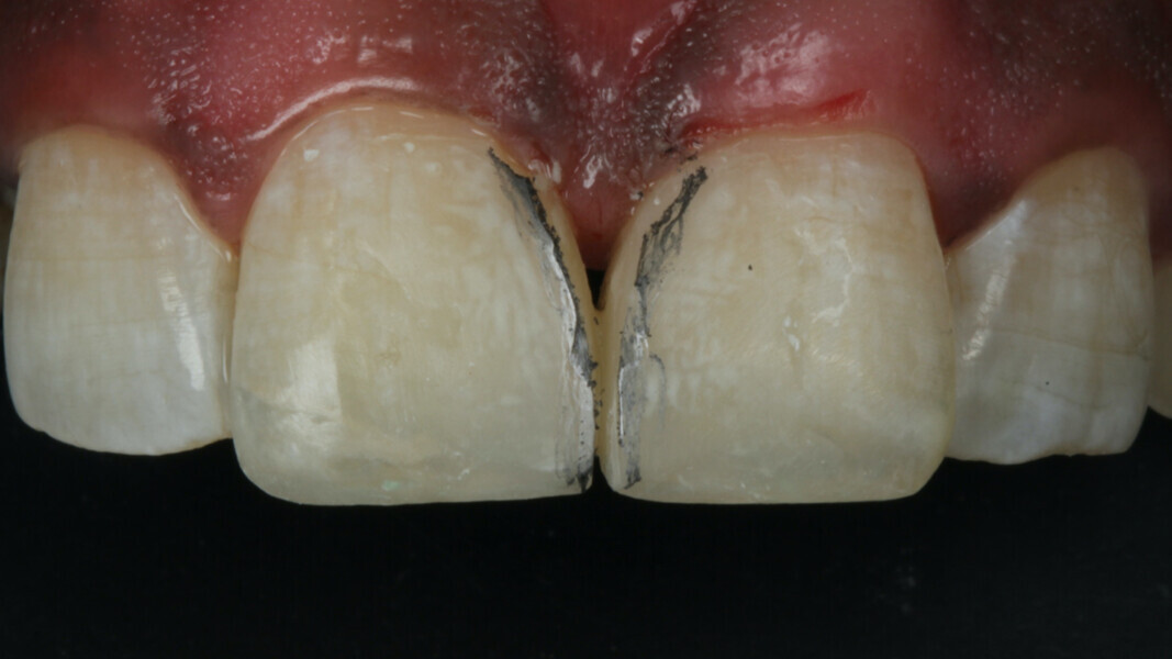 Fig 21. The Line angles are defined first with the help of pencil marking and then fine tuned with the help of fine finishing burs.