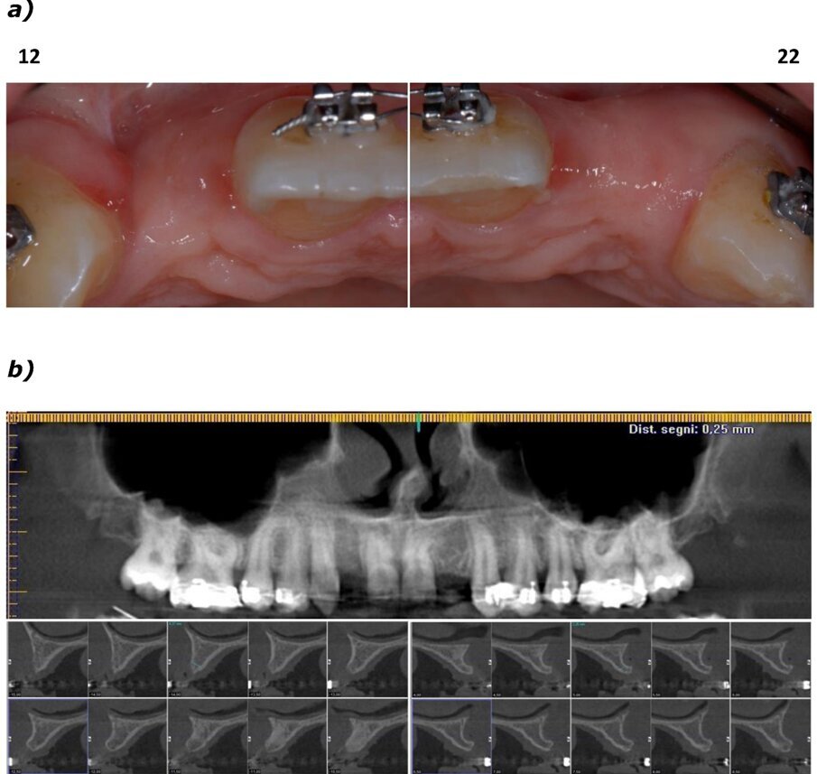 Fig. 2_Valutazione della disponibilità di spazio mesio-distale e di spessore dell’osso vestibolare; a) visione occlusale in corrispondenza degli elementi 12 e 22; b) immagine panoramica successiva a CBCT con sezione dell’osso vestibolare.