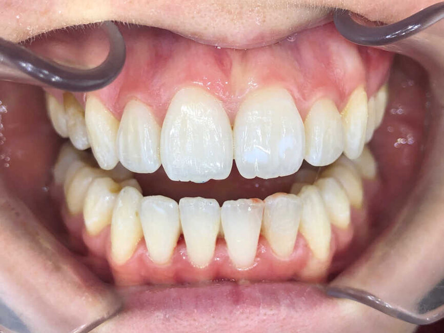 Photo de face fin de traitement (Copyright- Dr Edouard Negre)
