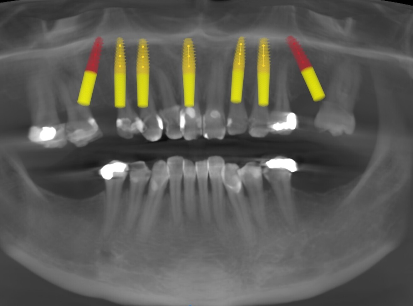 Fig. 4: Planning with the CS 8100 3D (Carestream Dental).