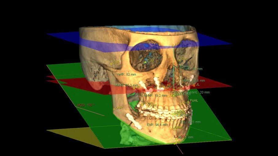 Fig. 2 - Cefalometria 3D multiplanare denominata Total Face Approach (TFA): valutazione di un caso post -chirurgico.