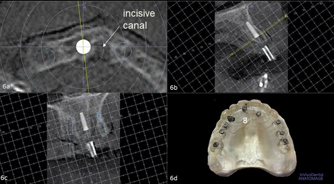 Figs. 6a–d: Virtual planning with the diagnostic guide placed intra-orally during the CBCT scan showing sufficient bone to accommodate a fixation screw in the maxillary right central incisor site and the need for a 1 mm linear distal correction to avoid the nasopalatine canal (a–c). Site on the duplicate denture (d).