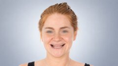 Approccio conservativo multimateriale alla riabilitazione full-mouth in un caso di grave usura dentale erosiva