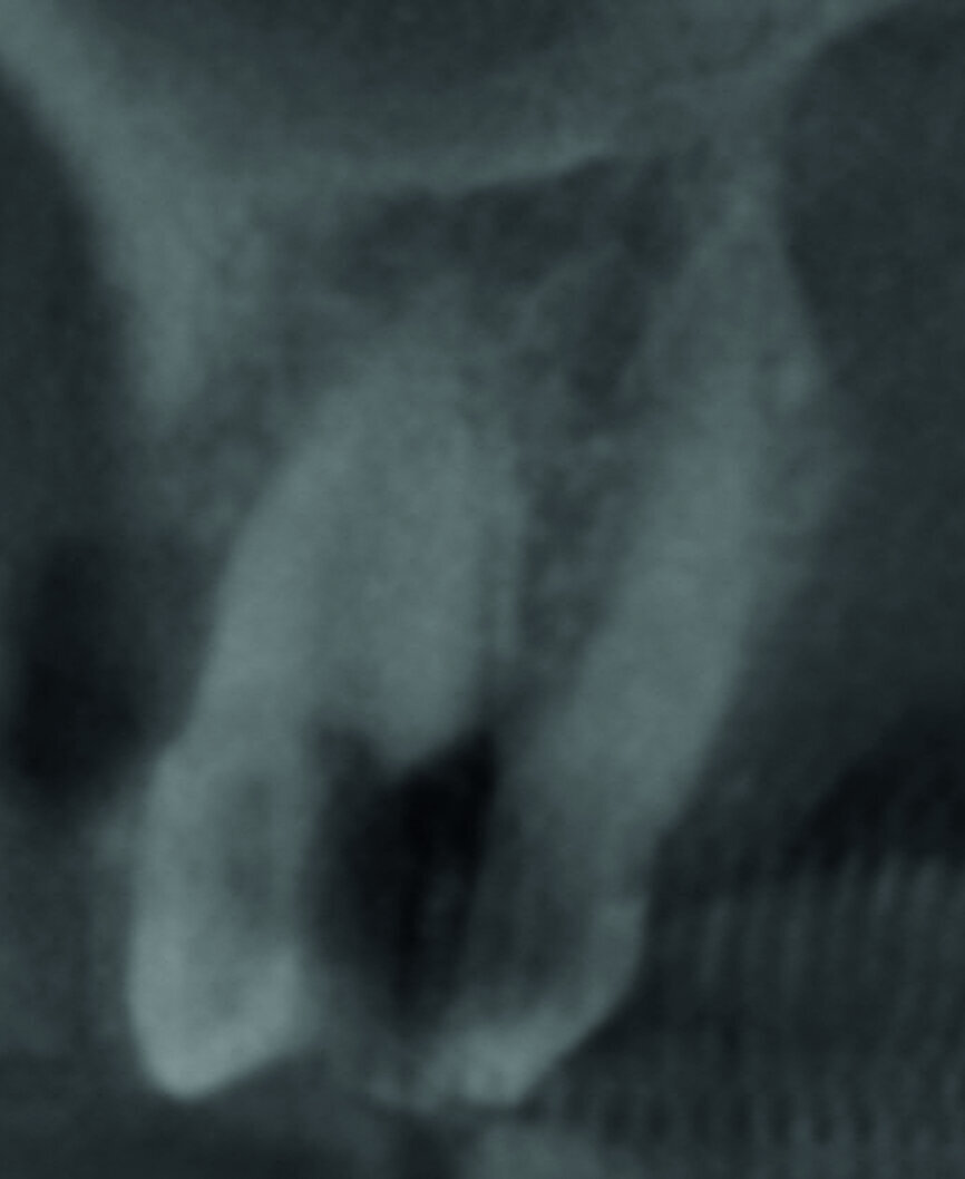 Figs. 1 et 2 : Tomodensitométrie à faisceau conique (CBCT) de la dent 27. 